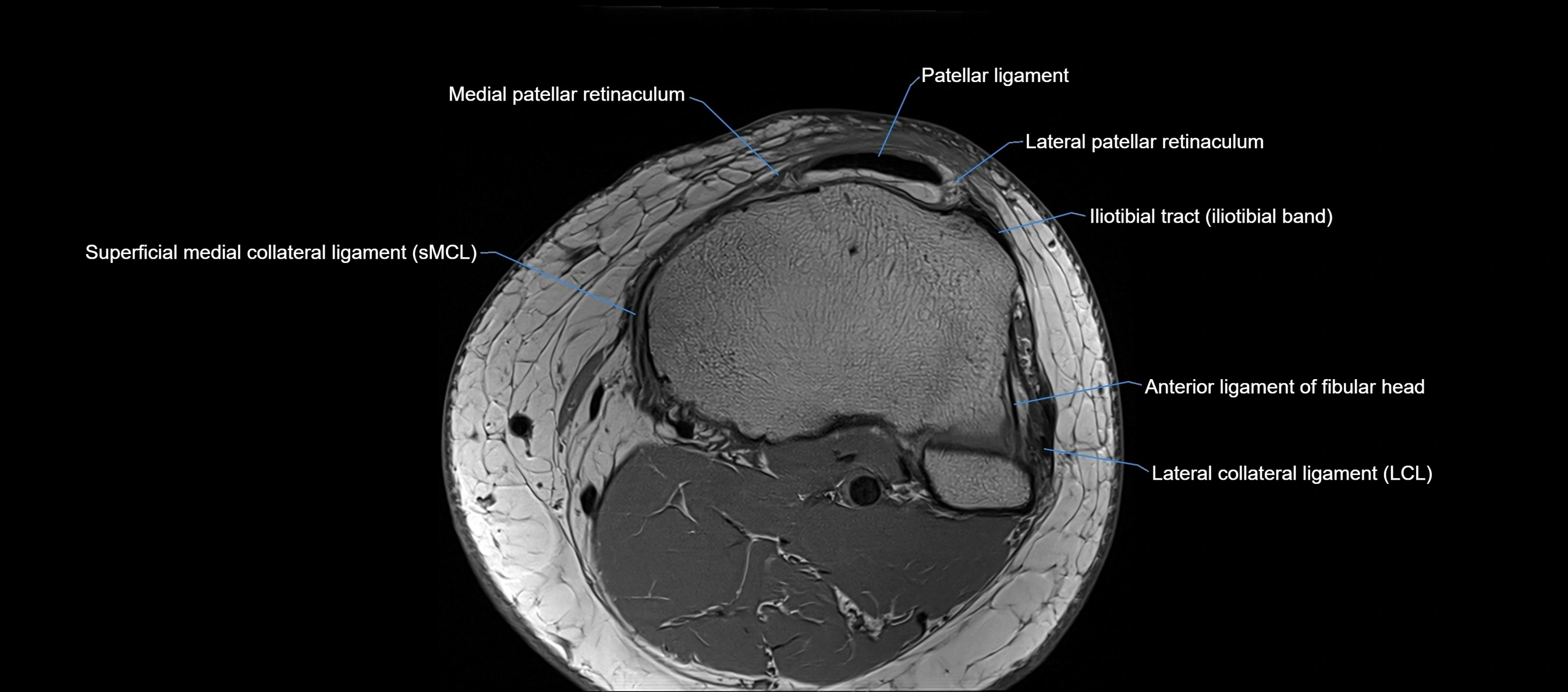 MRI Knee axial  ligaments cross sectional anatomy 3T  radiology  image-img-03001-00039.webp